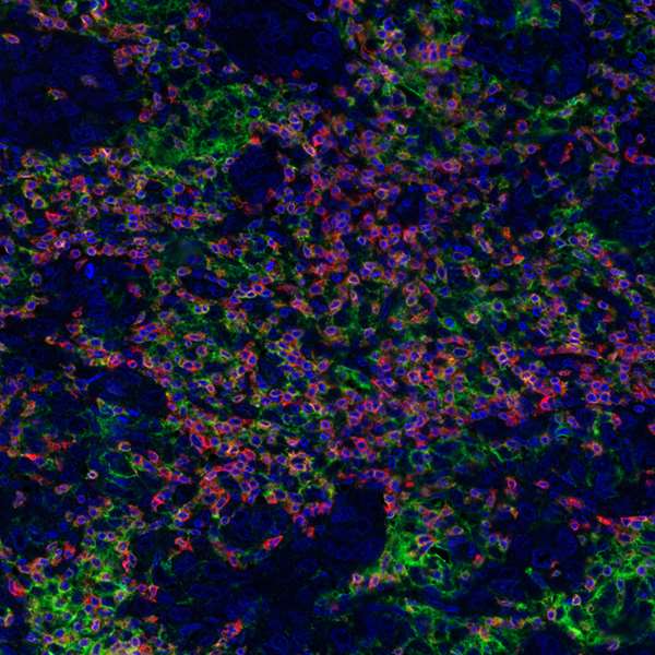 <b>Detection of human CD3E (orange), CD8 alpha (red), and PD-L1 (green) in FFPE breast carcinoma by IHC-IF.</b> Rabbit anti-CD3E recombinant monoclonal [BL-298-5D12] (A700-016), rabbit anti-CD8 alpha recombinant monoclonal [BLR044F] (A700-044), rabbit anti-PD-L1 recombinant monoclonal [BLR020E] (A700-020). Secondary: HRP-conjugated goat anti-rabbit IgG (A120-501P). Substrate: Opal™ 520, 620, and 690. Counterstain: DAPI (blue).